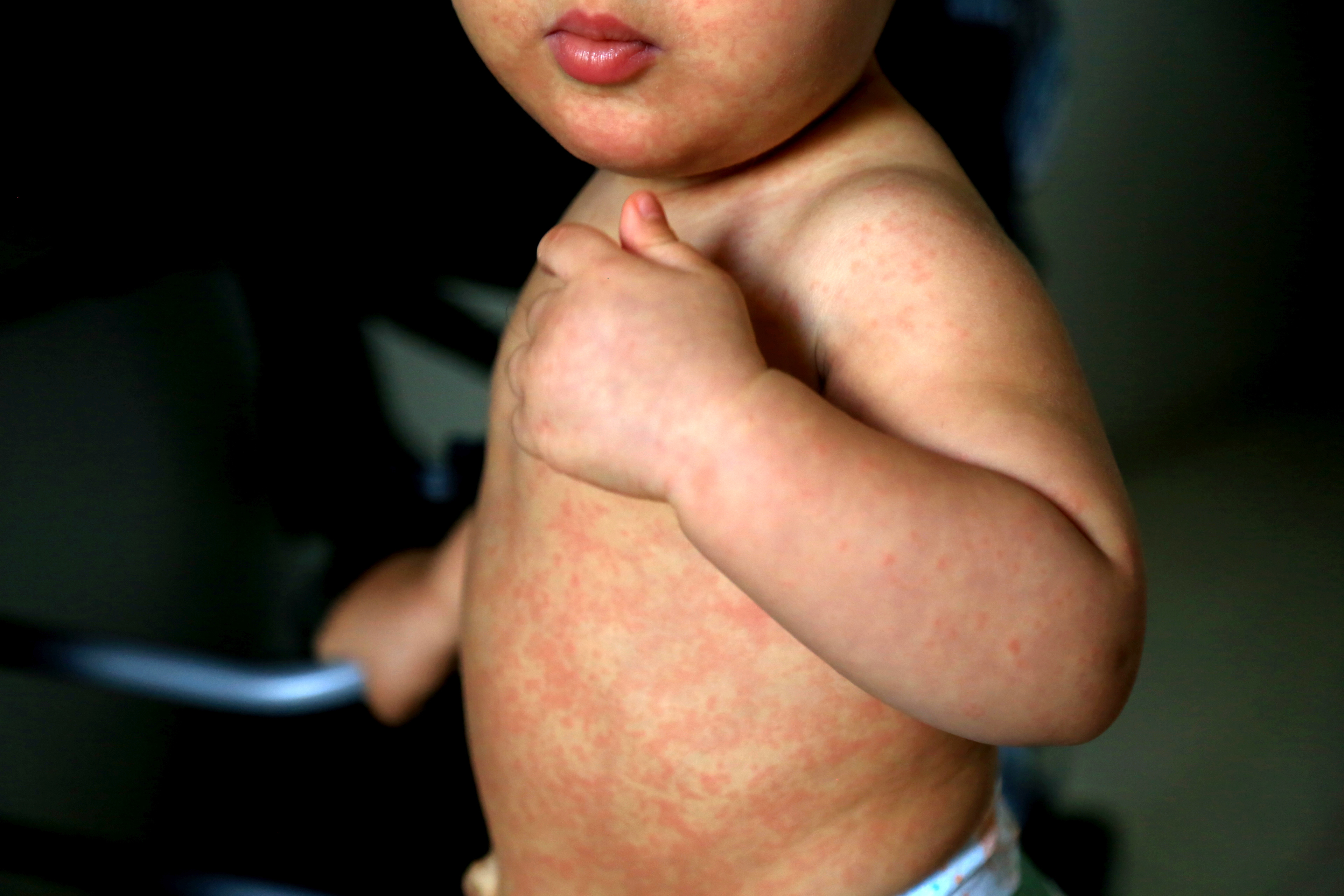 worried-about-measles-make-sure-your-child-gets-the-mmr-vaccine image